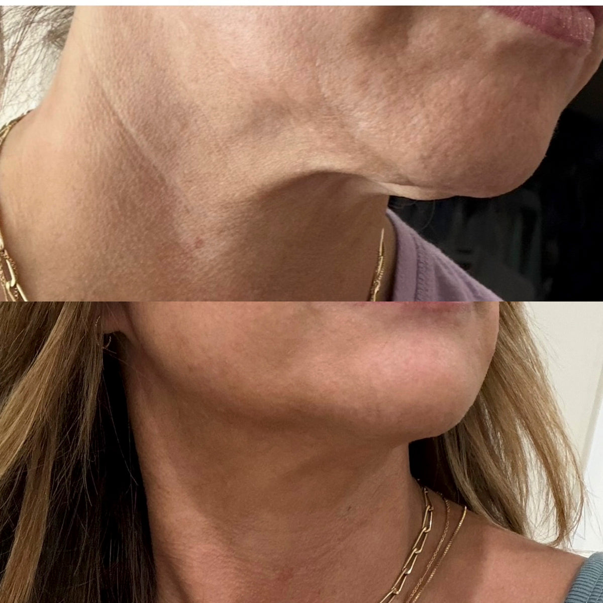 Arch Addicts ® TRIO (IPL + Skin Tightening + RF Laser Resurfacing)-Single Session