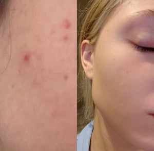 Venus Versa IPL Acne Treatment (Series of 8)