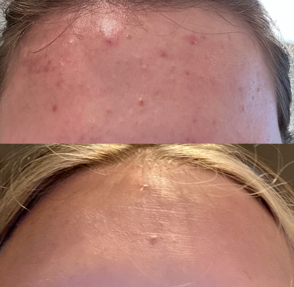 Venus Versa IPL Acne Treatment (Series of 8)