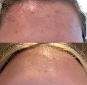 Venus Versa IPL Acne Treatment (Series of 8)
