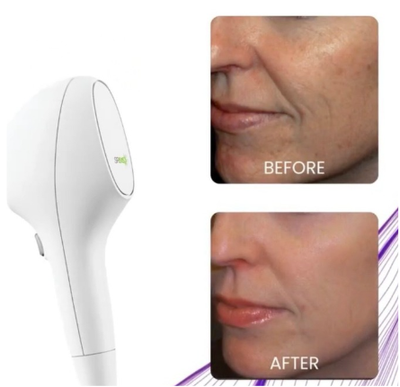 IPL (Intense Pulsed Light) Treatment